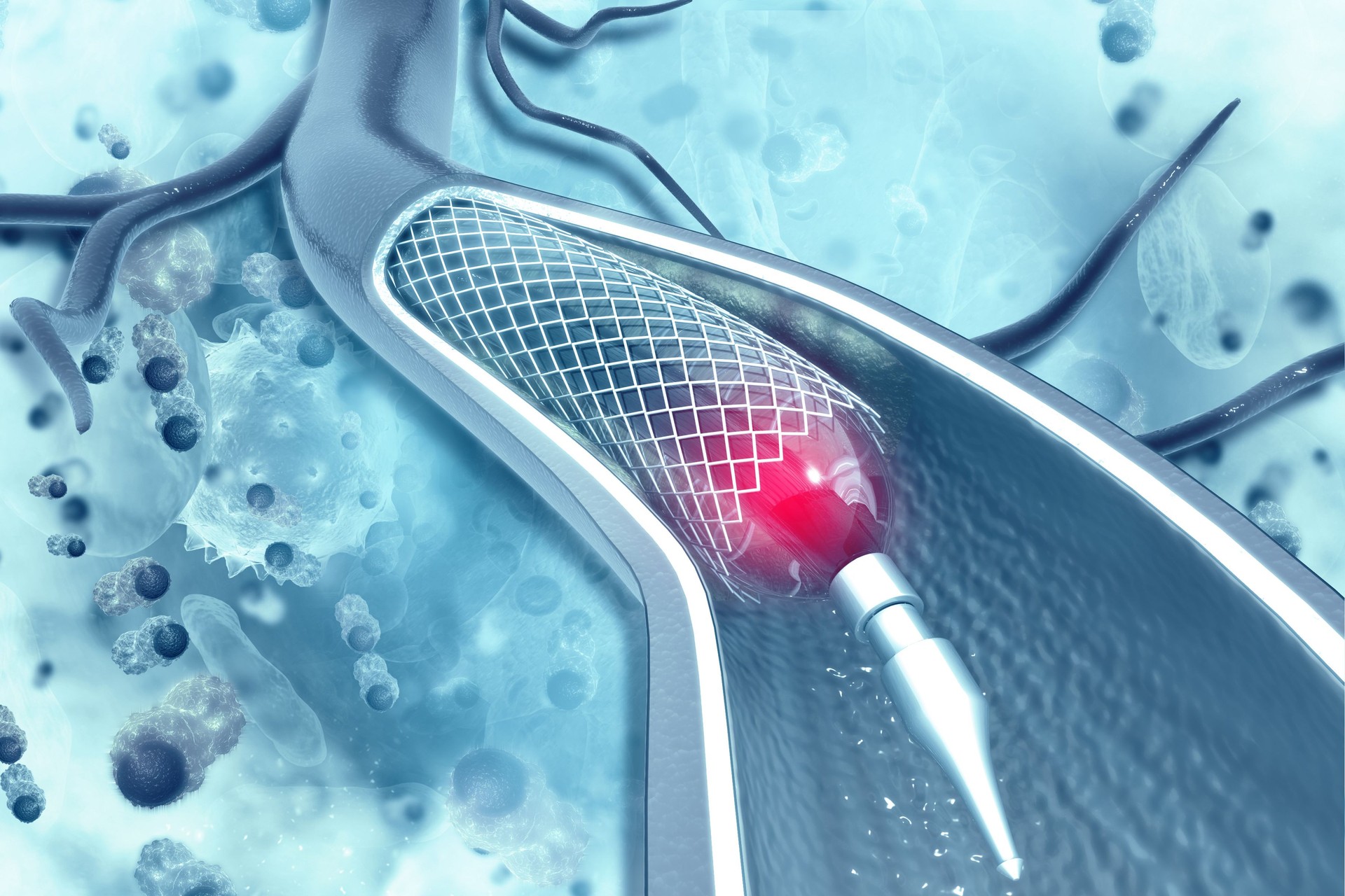 Stent angioplasty on scientific background